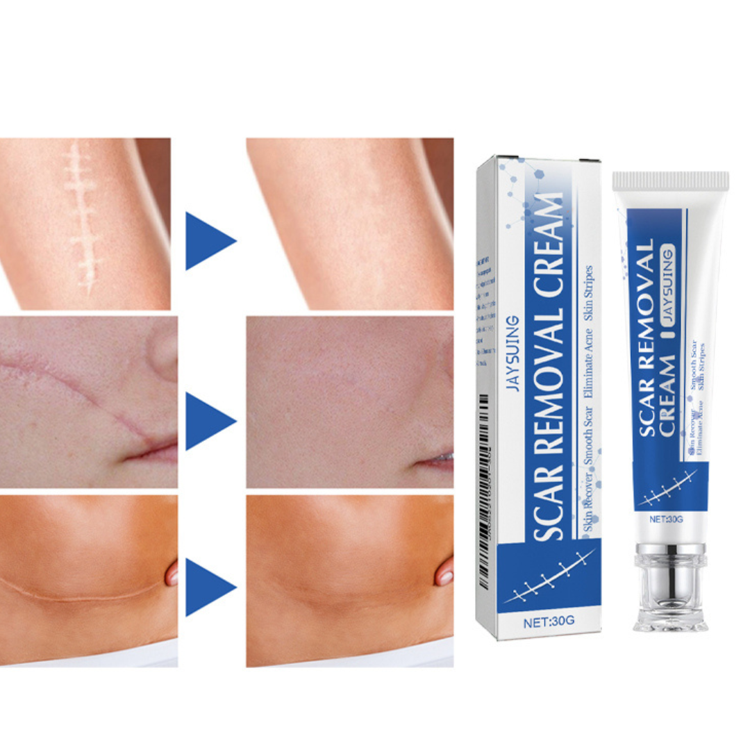Scar removal cream treatment
