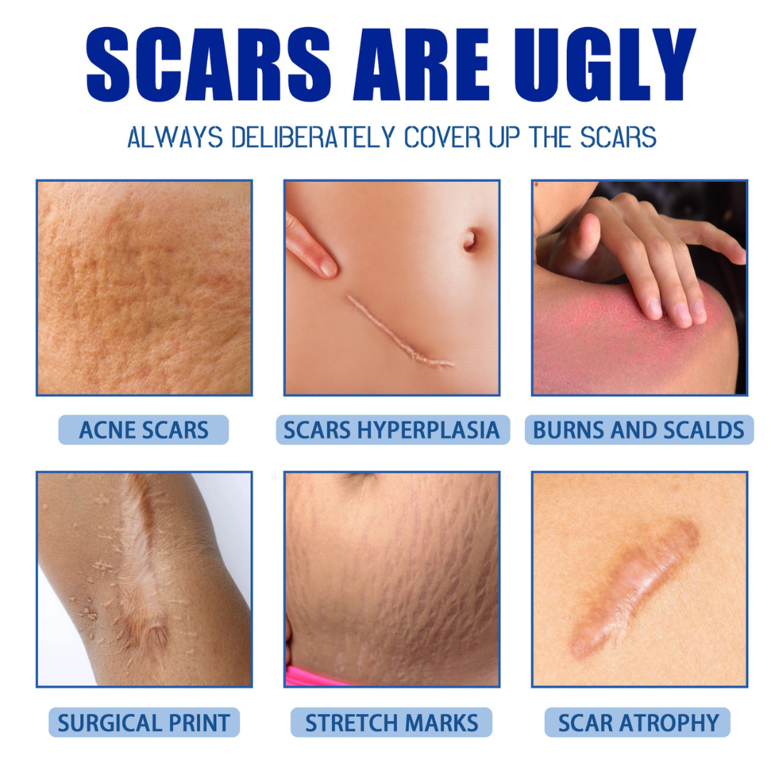 Scar removal cream treatment